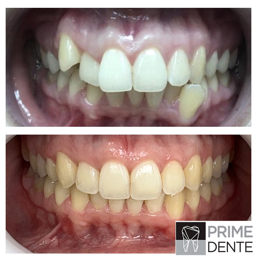 Invisalign Antes e Depois